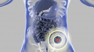 Čo spôsobuje nádor v hrubom čreve?
