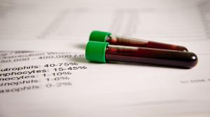 Krvný test na odhalenie rakoviny v rannom štádiu - Svetová novinka v liečbe rakoviny
